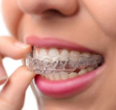 invisalign