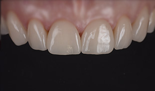 denti ceramica walter devoto