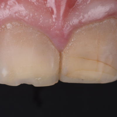 abrasione-erosione-dentale