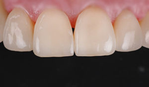 ceramica genova dentista sbiancamento