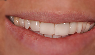 ceramica sorriso dentista