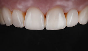 estetica dentale sbiancamento denti genova