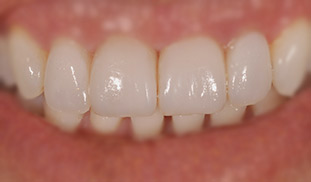 faccette dentali