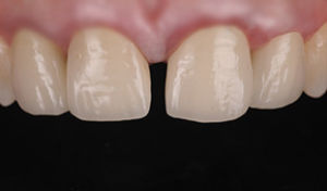 diastema ceramica dentista devoto