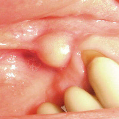 Dental abscess