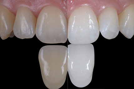 sbiancamento denti walter devoto genova