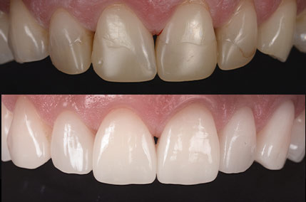 ceramica dente d'oro dentista walter devoto