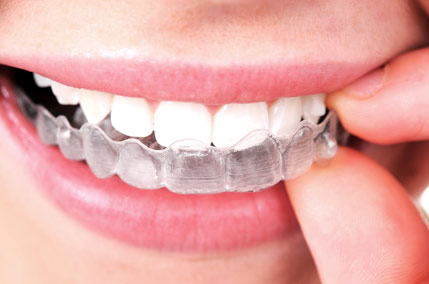invisalign genova valter devoto