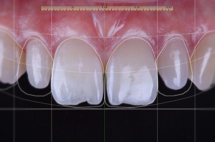 imperfezioni dentali